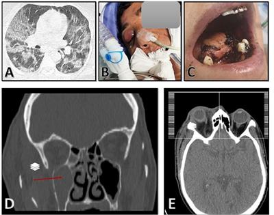 A case of COVID-19-associated rhino-orbito-cerebral mucormycosis caused by Apophysomyces variabilis with a review of the literature